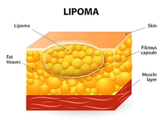 What is a Lipoma Glasgow