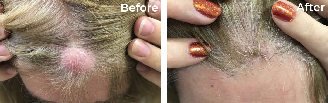 What Are Scalp Cysts and How Can They Be Treated?